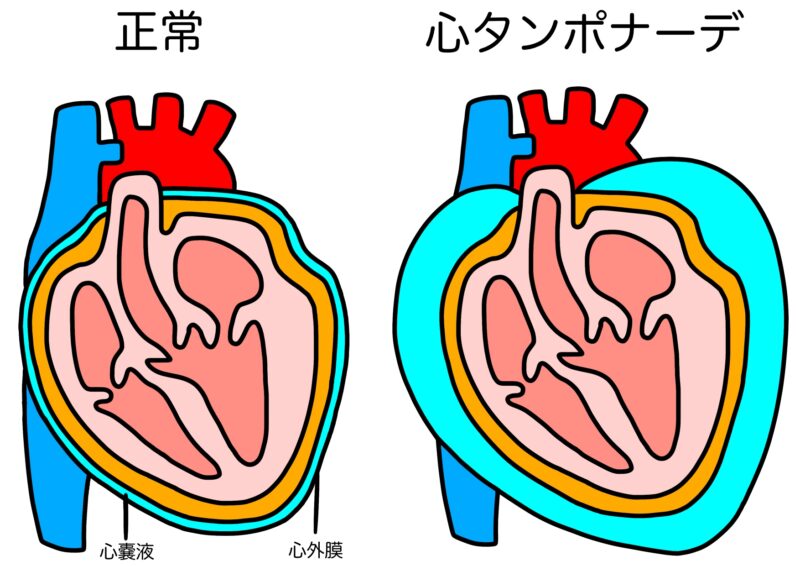 正常な心臓と心タンポナーデの心臓の比較